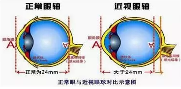 近視眼球突出？！控制近視度數(shù)加深是關(guān)鍵！