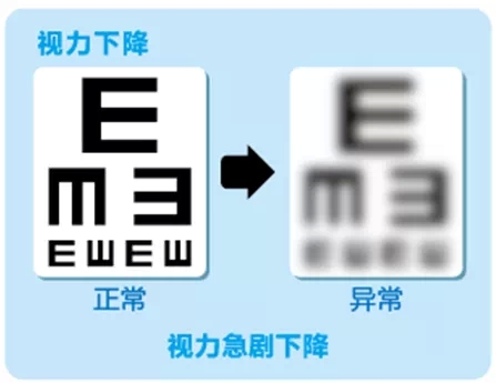 視網(wǎng)膜脫離啥癥狀？這張圖告訴你！