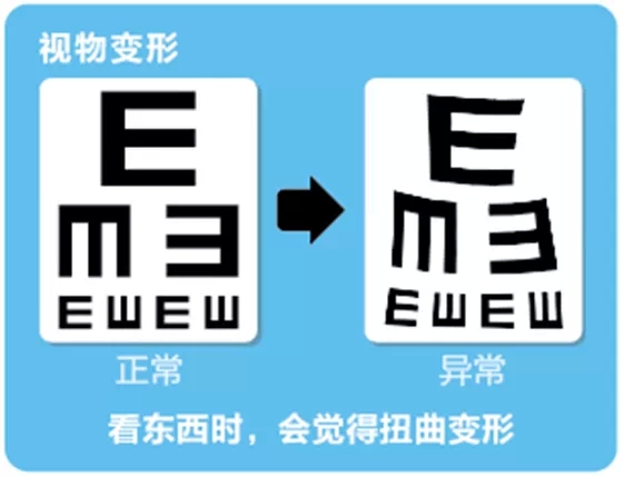 視網(wǎng)膜脫離啥癥狀？這張圖告訴你！