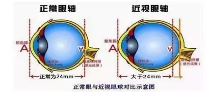 【專家解析】近視后眼球突出怎么辦