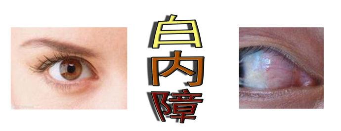 白內(nèi)障手術(shù)會反復(fù)嗎？