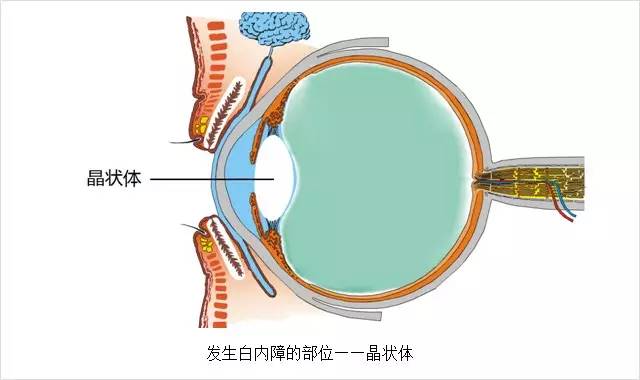 眼科主任告誡白內(nèi)障這幾大誤區(qū)，80%的老人上當(dāng)